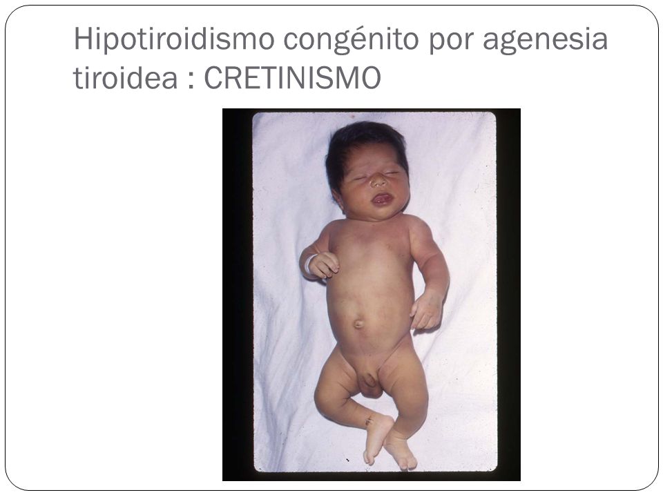 agenesia por tiroides agenesia por tiroides